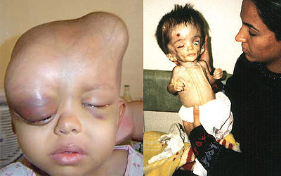 Niños víctimas del uranio empobrecido